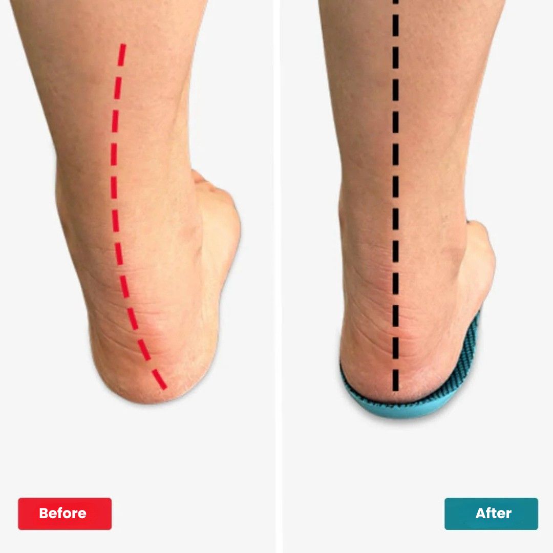 What Are Supination Orthotic Insoles